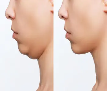lipo enzimatica de papada antes e depois 04