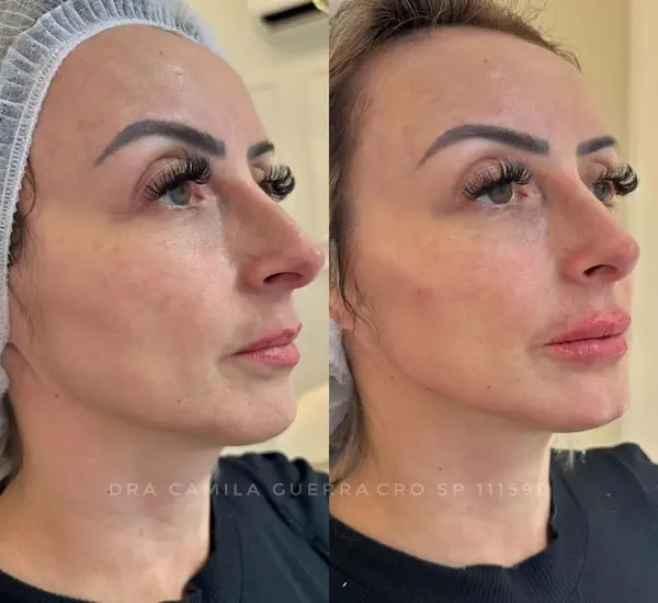 Preenchimento Facial com Ácido Hialurônico Antes e Depois 02