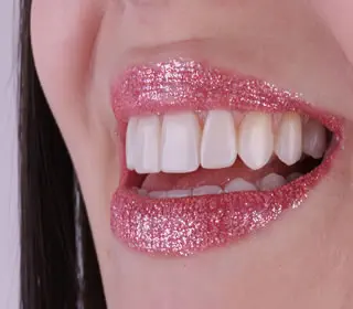 lente de contato dental e facetas de porcelana e resina 03