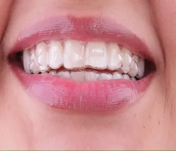 Invisalign Alinhador Transparente 1