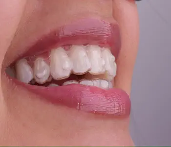Invisalign Alinhador Transparente 2