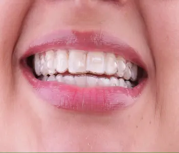 Invisalign Alinhador Transparente 3