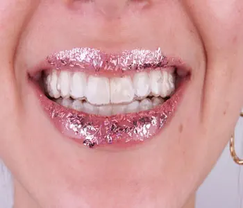 Invisalign Alinhador Transparente 4