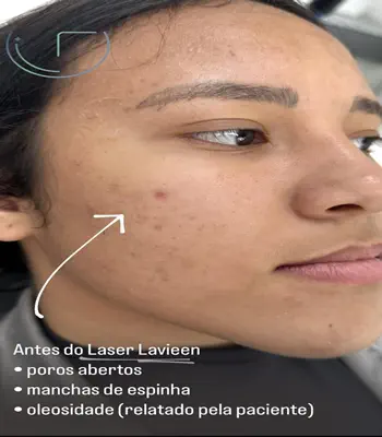 Laser Lavieen Antes e Depois na Av. Paulista 01