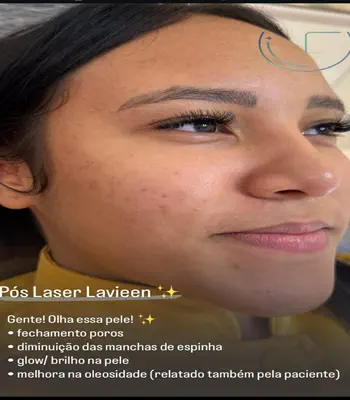 Laser Lavieen Antes e Depois na Av. Paulista 02