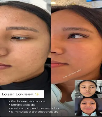 Laser Lavieen Antes e Depois na Av. Paulista 03