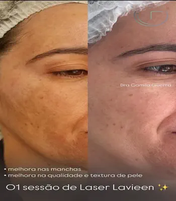 Laser Lavieen Antes e Depois na Av. Paulista 04