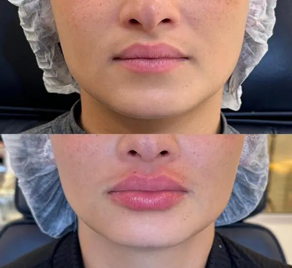 Resultado com antes e depois do preenchimento labial com ácido hialurônico na av. paulista, São Paulo.