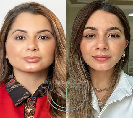 Antes e depois de harmonização facial com toxina botulínica e preenchimento em paciente jovem pela ICG Odontologia e Estética na Av. Paulista, destacando a suavização de traços e resultado natural.