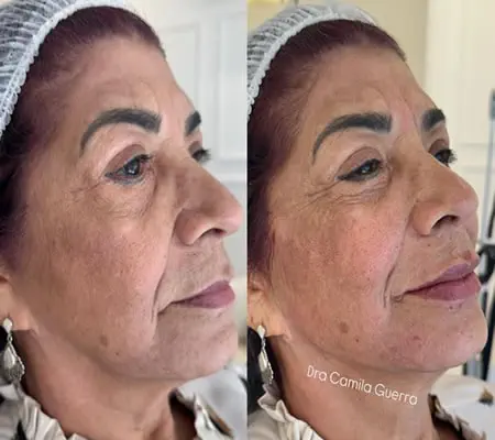 Comparativo de perfil antes e depois de rejuvenescimento facial na ICG Odontologia e Estética, mostrando a melhora do contorno mandibular, sulco nasogeniano e firmeza da pele.