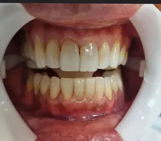 Clareamento Dental antes do procedimento no Instituto CGClin Av. Paulista. Clareamento Dental antes do procedimento no Instituto CGClin Av. Paulista.