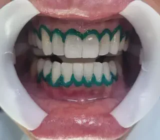 Clareamento Dental depois do procedimento no Instituto CGClin Av. Paulista. Clareamento Dental depois do procedimento no Instituto CGClin Av. Paulista.