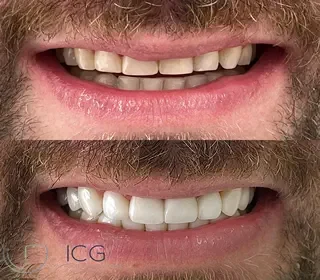 Paciente sorrindo após realizar clareamento dental no consultório na Av. Paulista. Close nos dentes brancos e saudáveis em ambiente clínico moderno em SP.